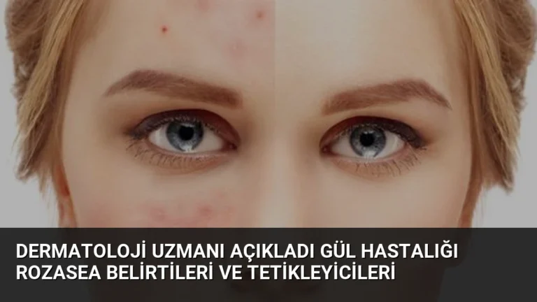 Dermatoloji Uzmanı Açıkladı Gül Hastalığı Rozasea Belirtileri ve Tetikleyicileri