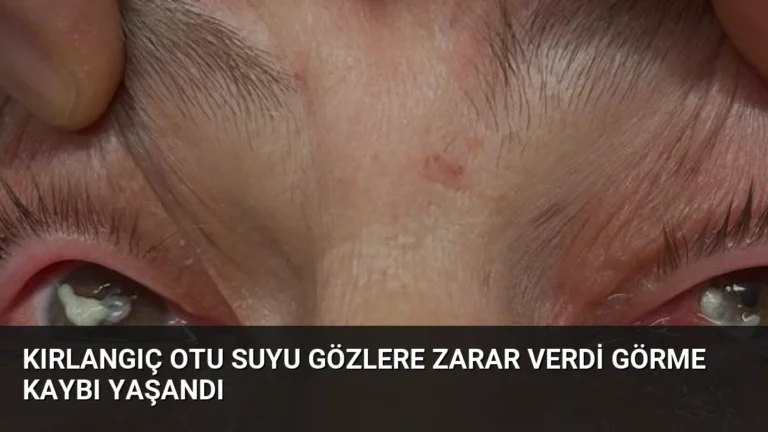 Kırlangıç Otu Suyu Gözlere Zarar Verdi Görme Kaybı Yaşandı