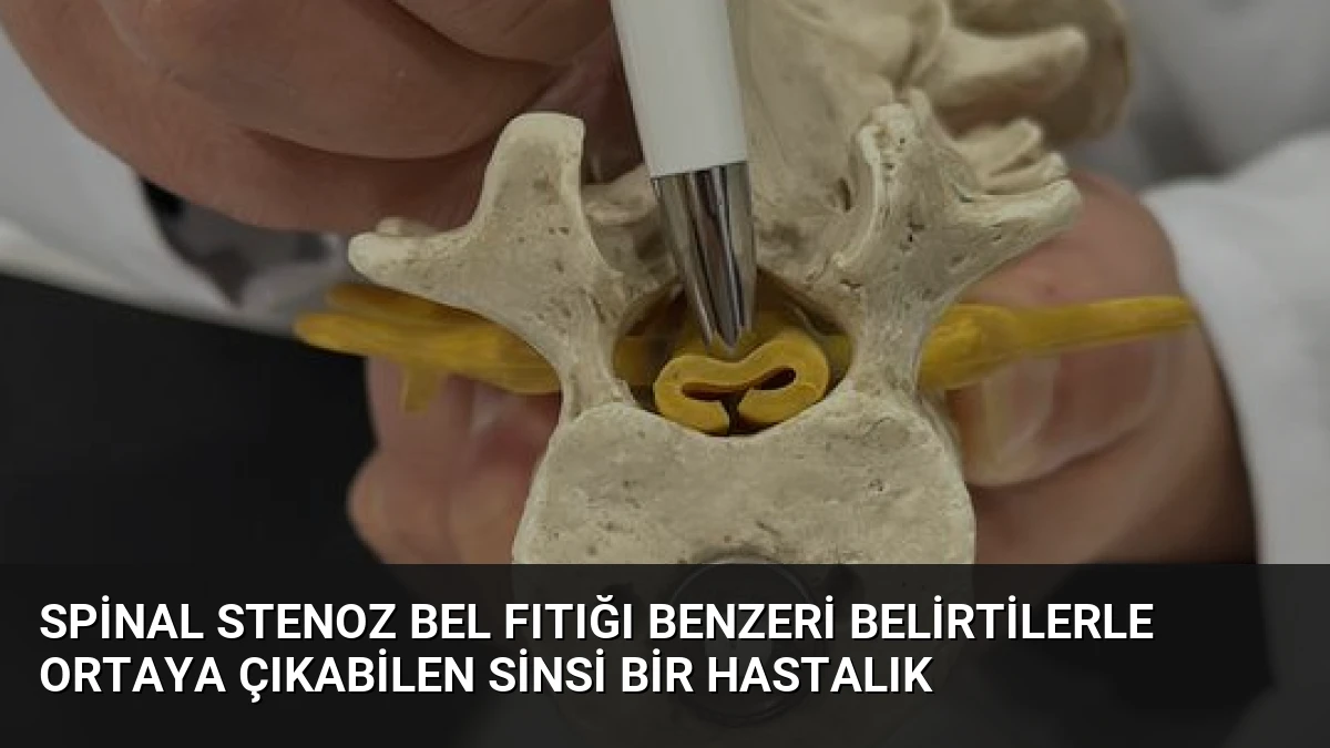 Spinal Stenoz Bel Fıtığı Benzeri Belirtilerle Ortaya Çıkabilen Sinsi Bir Hastalık