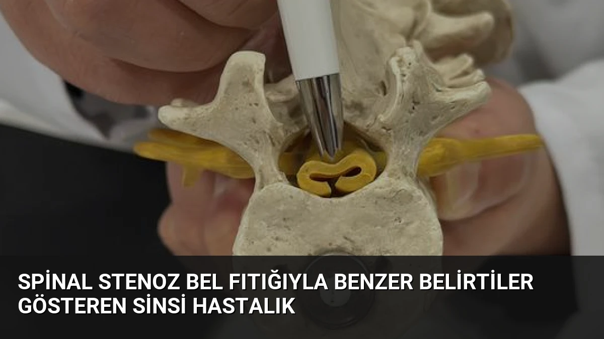 Spinal Stenoz Bel Fıtığıyla Benzer Belirtiler Gösteren Sinsi Hastalık